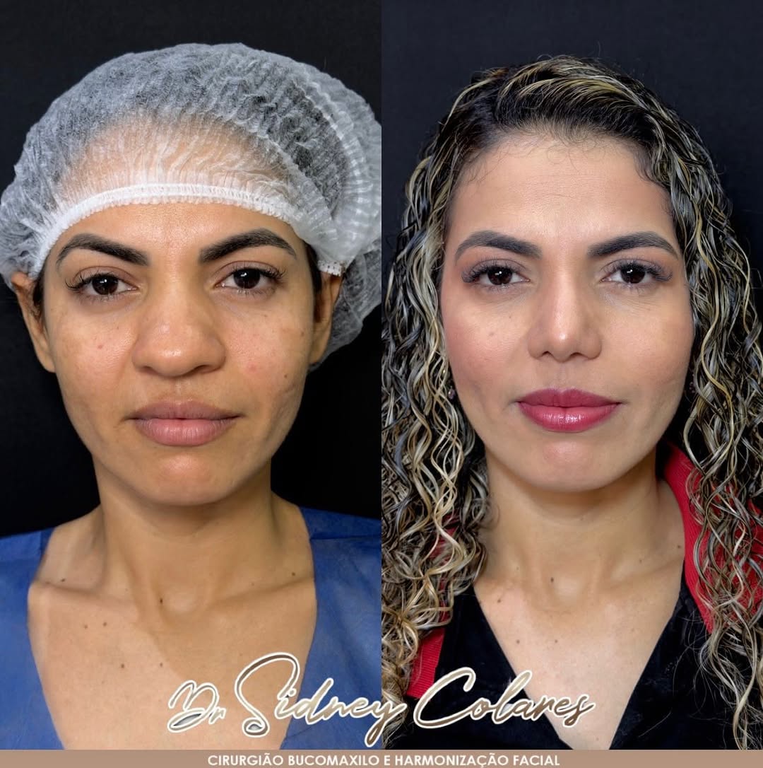Comparativo clínico frontal preservando os traços da paciente